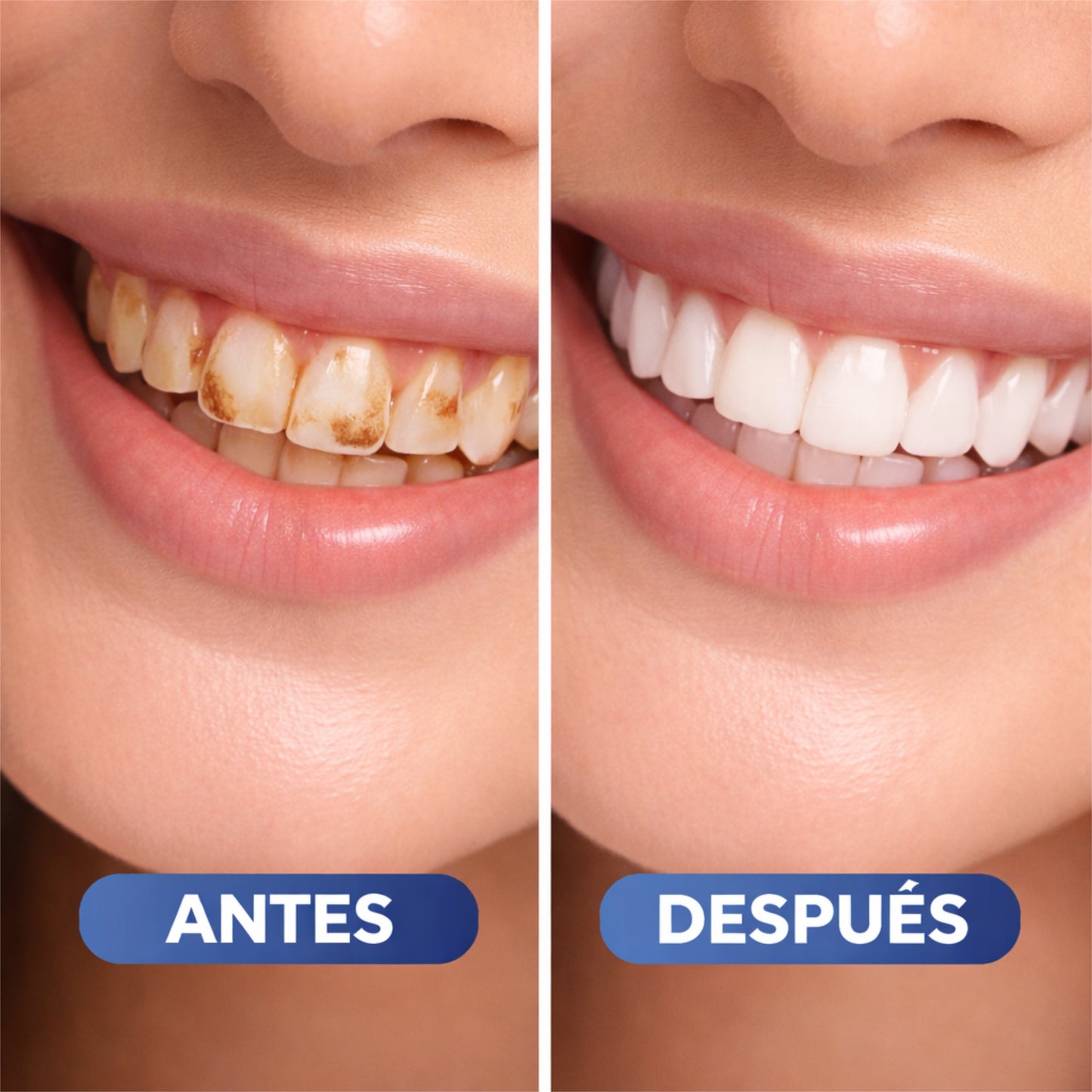 Lumidenta | Blanqueamiento Dental En Casa
