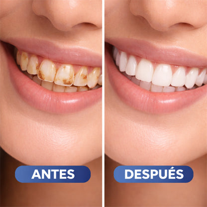 Lumidenta | Blanqueamiento Dental En Casa